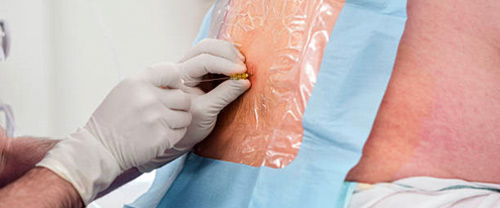 Nerve blocks